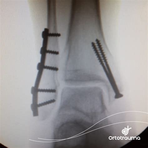 Imagens De Ortotrauma Fraturas E Ortopedia - Fraturas do tornozelo - Ortotrauma