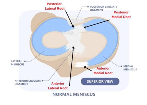 meniscus root tear torn meniscus specialist sugar land pearland