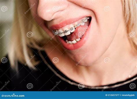 Blonde Woman Licking Teeth With Metal Braces Stock Image Image Of