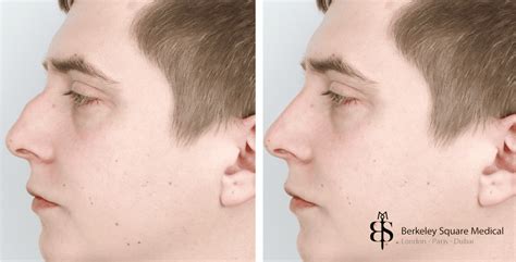 Dorsal Hump Rhinoplasty Berkeley Square Medical Central London