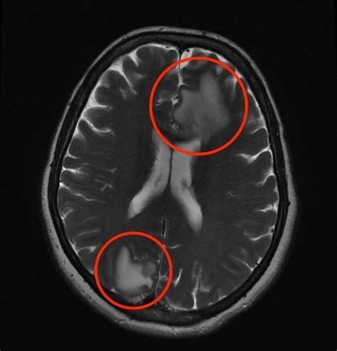 Craniotomy For Brain Tumor Resection Institute Of Neuro Innovation