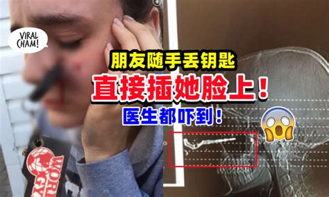 【可怕😱】朋友「随手丢车钥匙🔑」直接插她脸上💥 医生看了也傻眼！