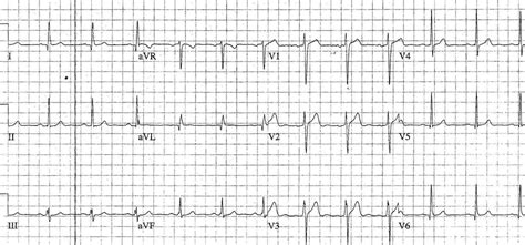 ECG Case 092 • LITFL • ECG Top 100 Self-Assessment Quiz