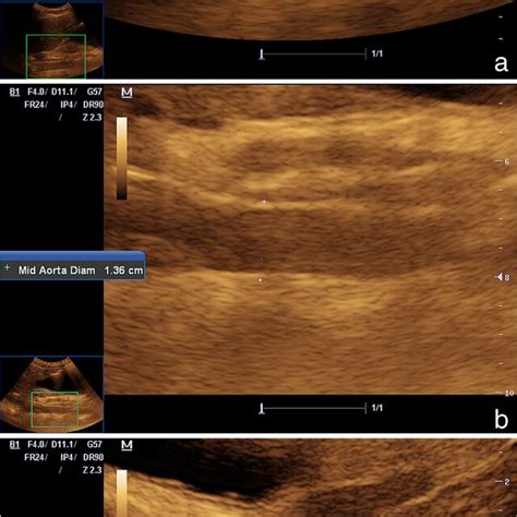Longitudinal Ultrasound Scans Between The Epigastric And Umbilical