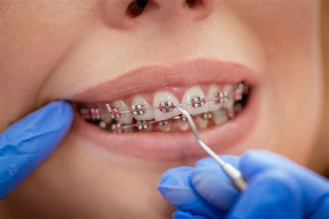 Braces For Crowded Teeth Comprehensive Guide To Treatment