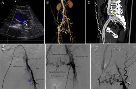 A Pre Operative Ultrasound Examination Arteriovenous Fistulae Avfs