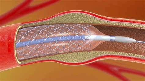 Stent Metallgerüst gegen verengte Gefäße