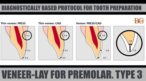 Veneer Prep Diagram