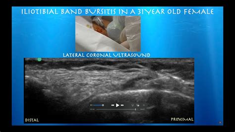 Ultrasound Guided Injection For Iliotibial Band Syndrome Youtube