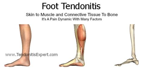 Foot Tendonitis Tendonitis In Foot 100 Fixable