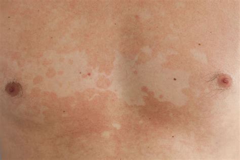 What Causes Skin Rash On Chest At Patricia Jackson Blog