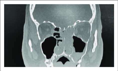 A Ct Scan Of The Paranasal Sinuses Showing The Presence Of Soft Tissue