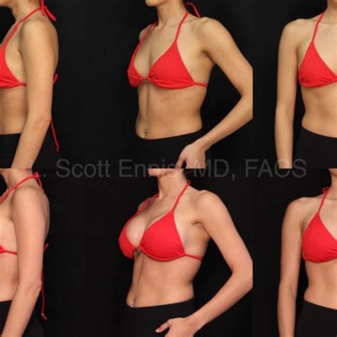 About Silicone Breast Implants By Dr Ennis In Boca Raton