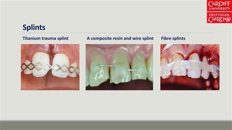 Traumatic Dental Injuries Ppt