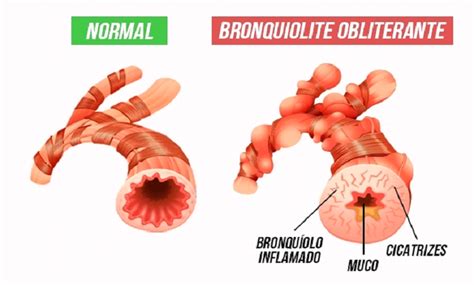 O'que Causa A Bronquiolite - A bronquiolite viral aguda causa dificuldades respitatórias