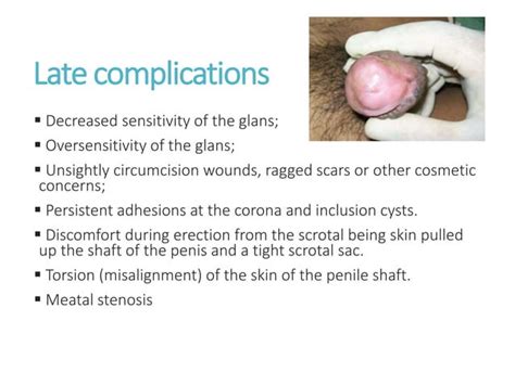 Basic Technique Of Circumcision By Regi Septian