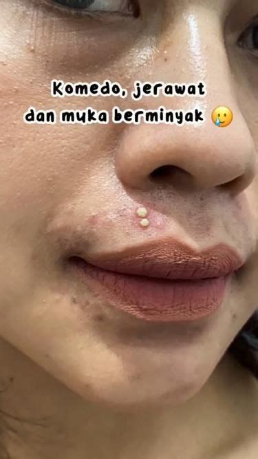 CARI LINK DI BIO NO 89 Jerawat Produk Jerawat Kulit Berminyak