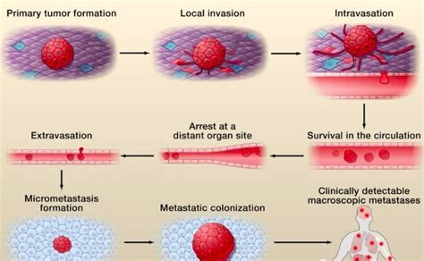 The Process of Tumor Cell Metastasis in the Body | Download Scientific ...