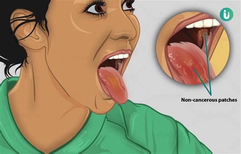 Leukoplakia Symptoms Causes Treatment Medicine Prevention Diagnosis