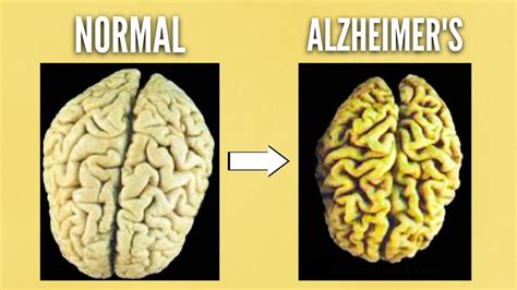 The BIGGEST Reason People Get Alzheimer S Disease DEMENTIA YouTube