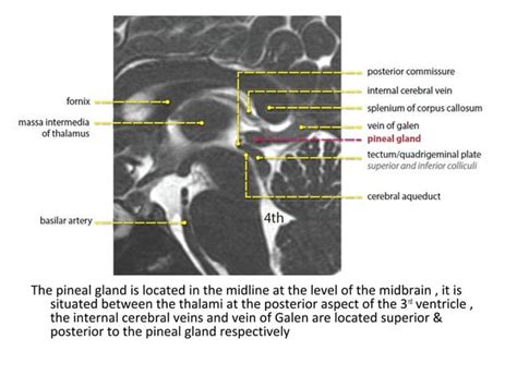 Diagnostic Imaging Of Pineal Region Masses PPT