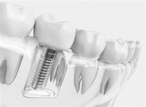 Dental Implant Vs Crown Pros And Cons Dental Implants By Best