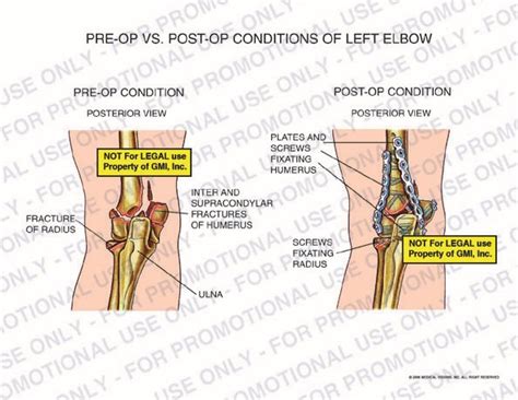 Pre Op Vs Post Op Conditions Of Left Elbow 95041baa Generic Medical Legal Exhibits A