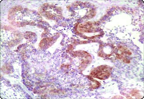 Plexiform Ameloblastoma With Strong Positive Cytoplasmic Expression Of