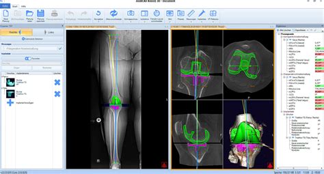 Medical Software Medicad Hectec Tracking Knee Leg