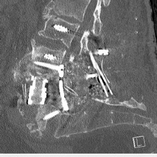 Intraoperative Lateral A And Anteroposterior AP B Fluoro