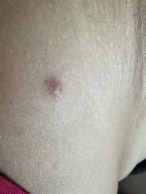 Could this be amelanotic melanoma? : r/DermatologyQuestions