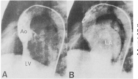 Figure 1 From Mucocutaneous Lymph Node Syndrome Kawasaki Disease