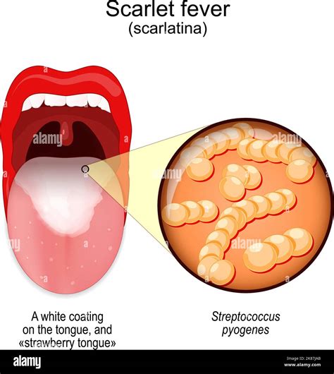 Scarlet fever. symptoms of scarlatina. Mouth with white coating on the ...