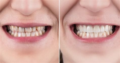 Dental Veneers Before And After – Witness The Transformation