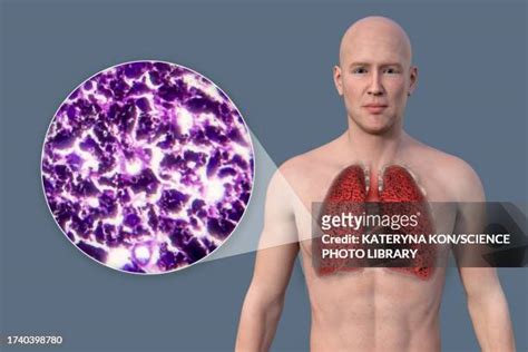 Smokers Lungs Images Photos And Premium High Res Pictures Getty Images