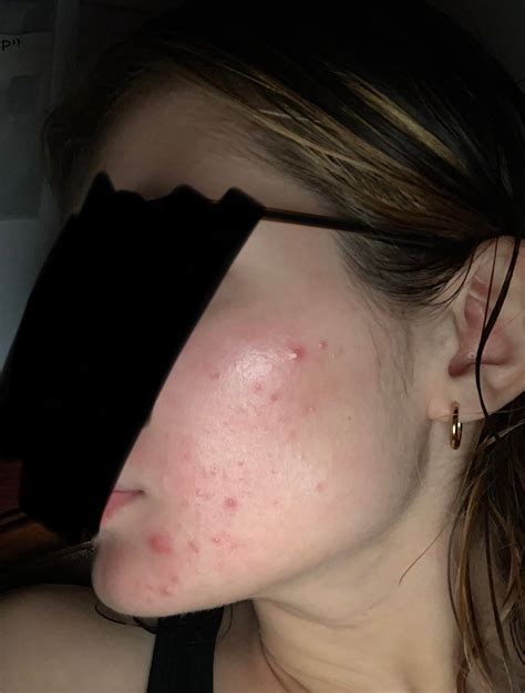 I still have bad skin days but I’m proud of the progress [B&A