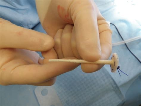 Anal Abscess And Anal Fistula