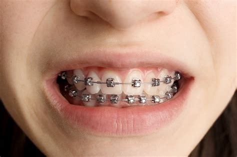 Cuts in Mouth from Braces - Pezoldt Orthodontics