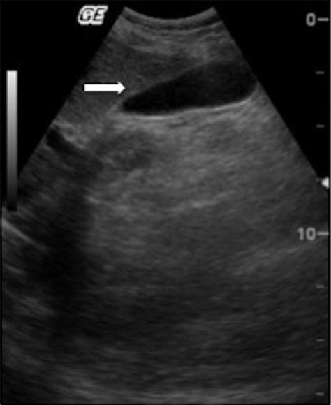 Acute Acalculous Cholecystitis In A Patient With Juvenile Dermatomyositis Bmj Case Reports