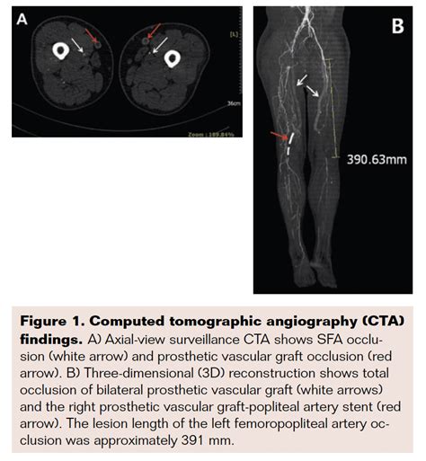 Laser Atherectomy For Chronic Fempop Artery Occlusion Vdm