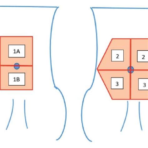 Reconstructive abdominal zones-1A= upper midline, 1B= lower midline, 2 ...