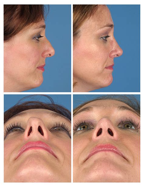 Rhinoplasty Before And After Photos