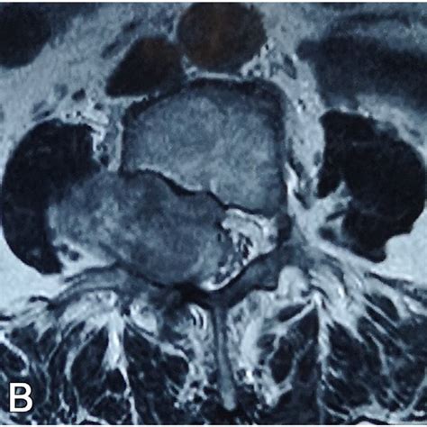 T1 Weighted Sagittal Mri A And T2 Weighted Axial Mri B Revealed A