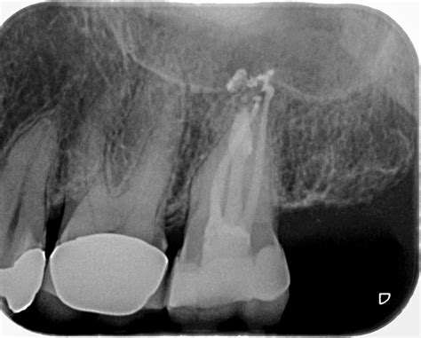 Zahn Interne Resorption Apikale Aufhellung Wurzelspitze