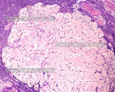 Corpus Albicans Gynecology . Ective Tissue. Thehyalin Colorless Masses