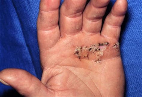 Electrical Injuries Slideshow