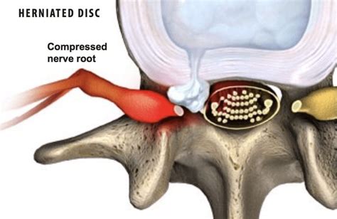 Lumbar Herniated Disc - Florida Surgery Consultants