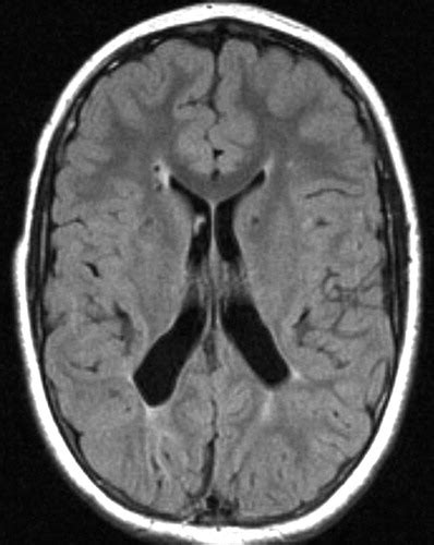 Hypoxic Ischemic Brain Injury Imaging Findings From Birth To Adulthood