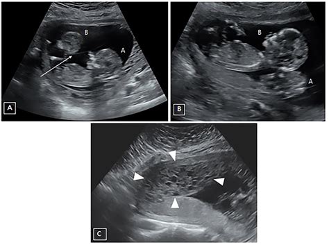 Partial Molar Pregnancy Twins