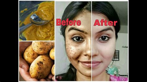 How To Remove Dark Spots On Legs Fast Naturally How You Can Remove